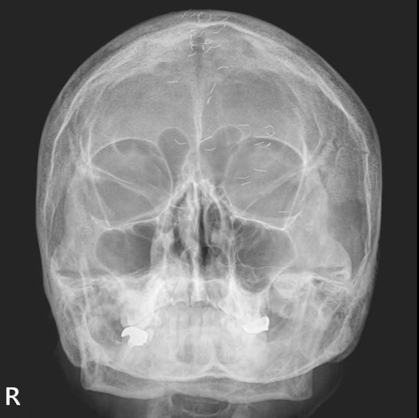 The head X-ray image of a female patient in her 60s was publicly shared by the head of the Department of Family Medicine at Uijeongbu Paik Hospital on social media. / Instagram@shiningdoctor