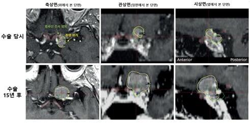 MRI images of a 55-year-old female patient showing the area adjacent to the optic nerve at the time of surgery (top) and 15 years later (bottom). Although radiation was not administered to part of the tumor at the time of surgery to protect the optic nerve, the tumor regrew 15 years later in the area that had previously been spared from radiation / Provided by Seoul National University Hospital