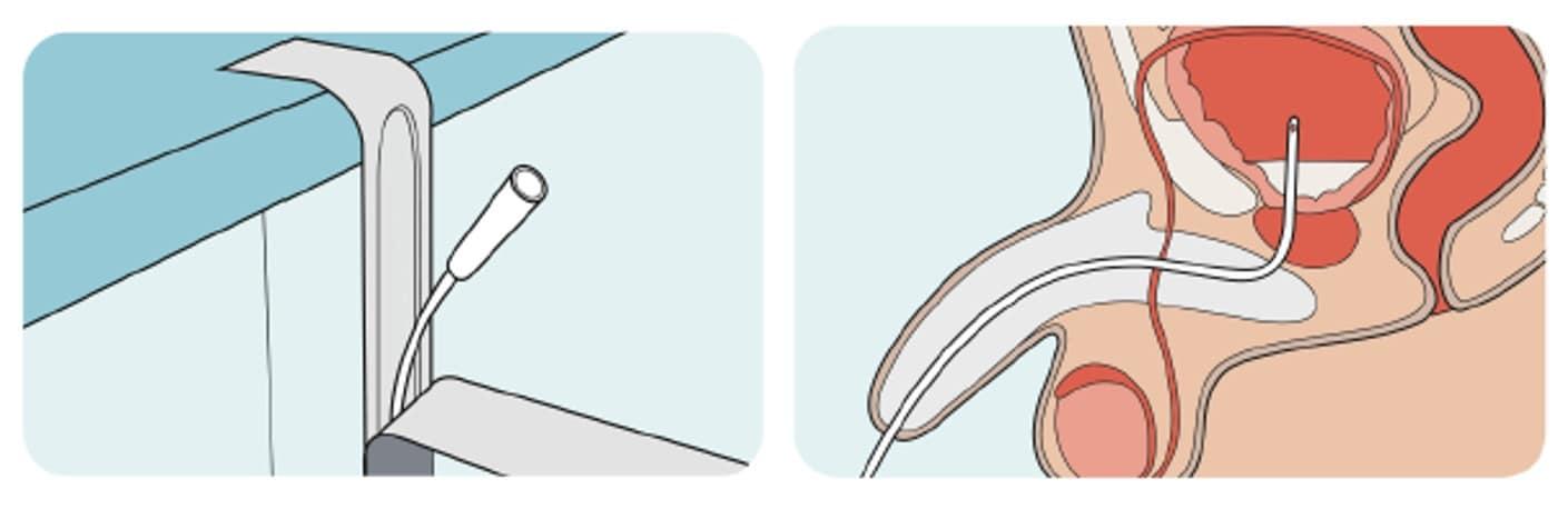 Clean intermittent catheterization, where patients with neurogenic bladder insert a disposable catheter into the bladder to empty it / Provided by Seoul St. Mary's Hospital