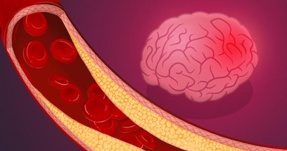 Man Finds Brain Aneurysm by Accident—Here’s What You Should Know