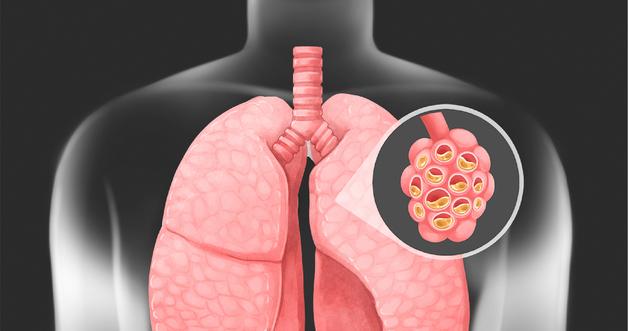 New Hope for IPF Patients: How Jascayd is Revolutionizing Treatment in 2026