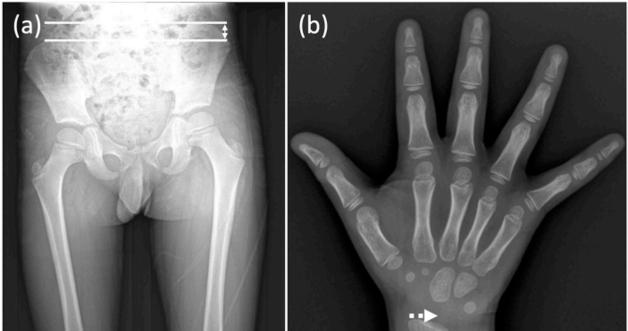 Researchers Identify Bone Age Differences Between Limbs in Rare Pediatric Overgrowth Disorders